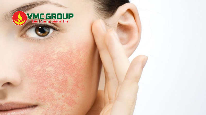 Người có da nhạy cảm nên cân nhắc dùng mỹ phẩm chứa DMDMH