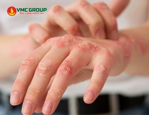 Thuốc tím giúp điều trị nấm da