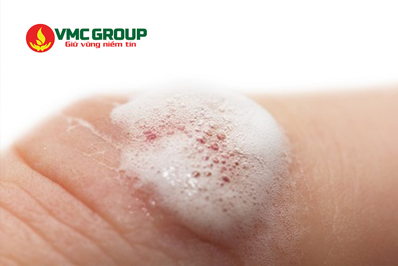 Oxy già dùng sát trùng vết thương hiệu quả