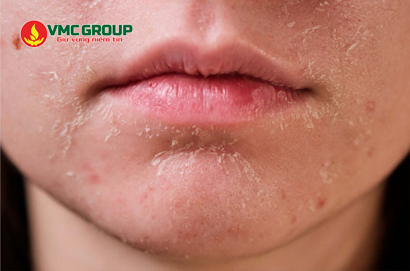 Sử dụng SLS trong mỹ phẩm với nồng độ quá cao có thể gây khô da