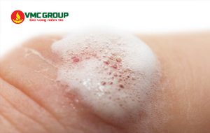 Hydrogen peroxide được dùng nhiều trong sát trùng vết thương