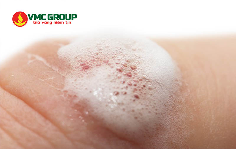 Hydrogen peroxide được dùng nhiều trong sát trùng vết thương