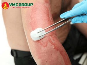 Acid Flohydric có nguy hiểm không?