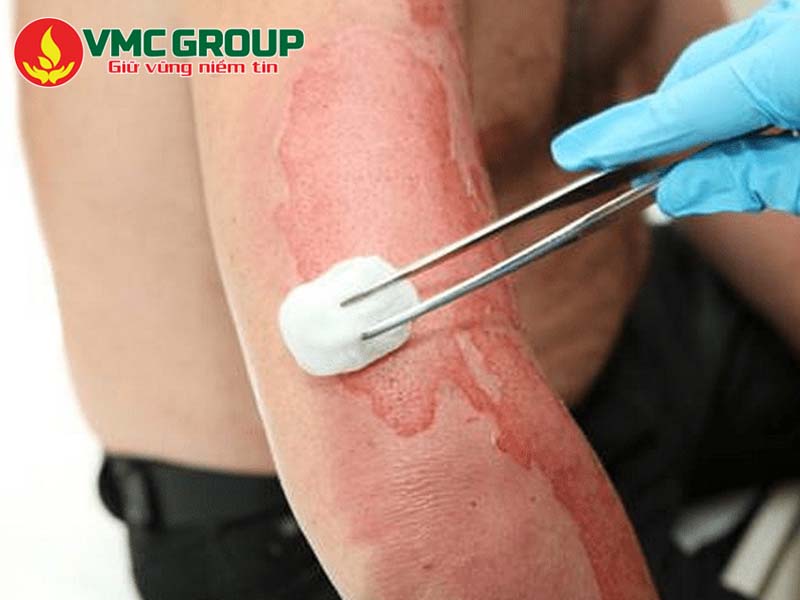 Acid Flohydric có nguy hiểm không?